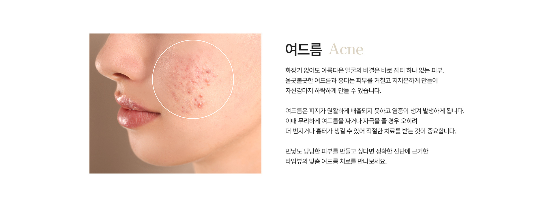 여드름 정의